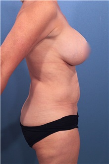 Liposuction Before Photo by Marvin Shienbaum, MD; Brandon, FL - Case 30325