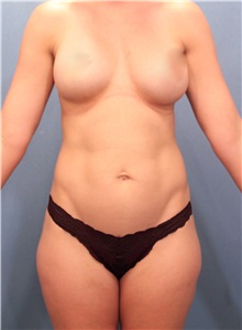 Liposuction Before Photo by Marvin Shienbaum, MD; Brandon, FL - Case 30327