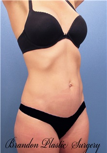 Liposuction After Photo by Marvin Shienbaum, MD; Brandon, FL - Case 30327