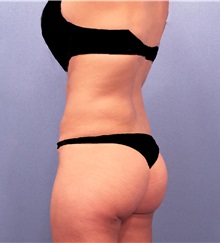 Liposuction After Photo by Marvin Shienbaum, MD; Brandon, FL - Case 30332