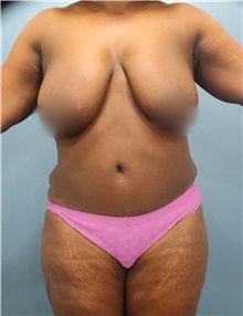 Liposuction Before Photo by Marvin Shienbaum, MD; Brandon, FL - Case 30334