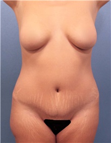 Liposuction Before Photo by Marvin Shienbaum, MD; Brandon, FL - Case 30349