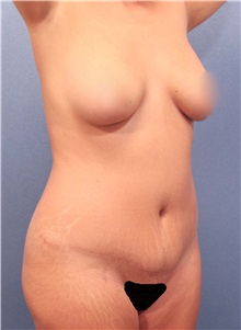 Liposuction Before Photo by Marvin Shienbaum, MD; Brandon, FL - Case 30349