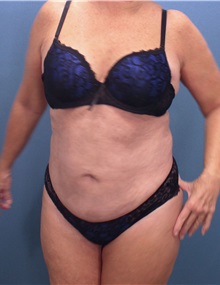 Liposuction After Photo by Marvin Shienbaum, MD; Brandon, FL - Case 30350