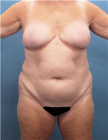 Liposuction Before Photo by Marvin Shienbaum, MD; Brandon, FL - Case 30350