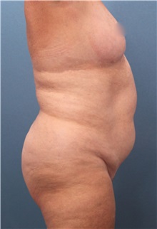 Liposuction Before Photo by Marvin Shienbaum, MD; Brandon, FL - Case 30350