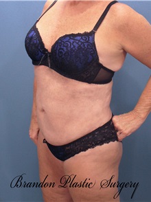 Liposuction After Photo by Marvin Shienbaum, MD; Brandon, FL - Case 30350