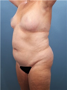 Liposuction Before Photo by Marvin Shienbaum, MD; Brandon, FL - Case 30350