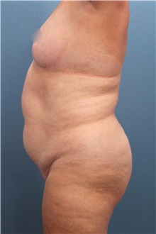 Liposuction Before Photo by Marvin Shienbaum, MD; Brandon, FL - Case 30350