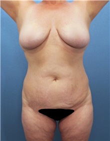 Liposuction Before Photo by Marvin Shienbaum, MD; Brandon, FL - Case 30351