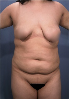 Liposuction Before Photo by Marvin Shienbaum, MD; Brandon, FL - Case 30352