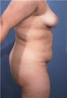 Liposuction Before Photo by Marvin Shienbaum, MD; Brandon, FL - Case 30352