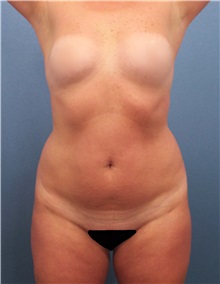 Liposuction Before Photo by Marvin Shienbaum, MD; Brandon, FL - Case 30353