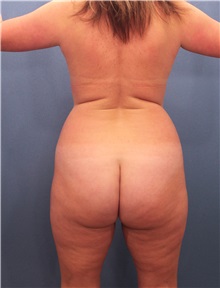 Liposuction Before Photo by Marvin Shienbaum, MD; Brandon, FL - Case 30353