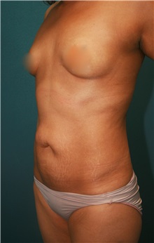 Liposuction Before Photo by Marvin Shienbaum, MD; Brandon, FL - Case 30354