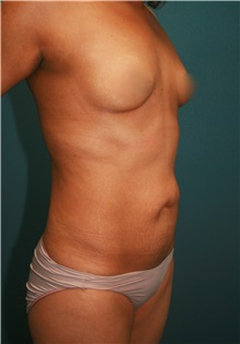 Liposuction Before Photo by Marvin Shienbaum, MD; Brandon, FL - Case 30354