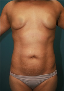 Liposuction Before Photo by Marvin Shienbaum, MD; Brandon, FL - Case 30354