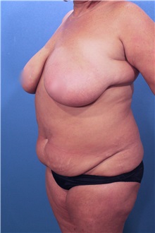Liposuction Before Photo by Marvin Shienbaum, MD; Brandon, FL - Case 30356