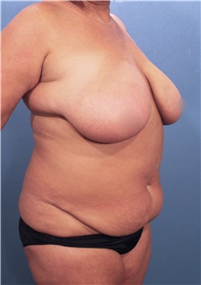 Liposuction Before Photo by Marvin Shienbaum, MD; Brandon, FL - Case 30356