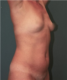 Liposuction Before Photo by Marvin Shienbaum, MD; Brandon, FL - Case 30363