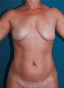 Liposuction Before Photo by Marvin Shienbaum, MD; Brandon, FL - Case 30363