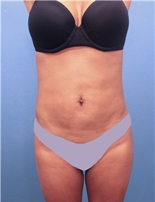 Liposuction After Photo by Marvin Shienbaum, MD; Brandon, FL - Case 30365