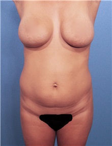 Liposuction Before Photo by Marvin Shienbaum, MD; Brandon, FL - Case 30365