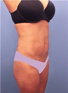 Liposuction After Photo by Marvin Shienbaum, MD; Brandon, FL - Case 30365