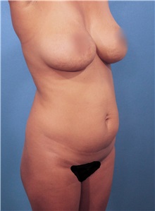 Liposuction Before Photo by Marvin Shienbaum, MD; Brandon, FL - Case 30365