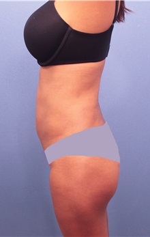 Liposuction After Photo by Marvin Shienbaum, MD; Brandon, FL - Case 30365