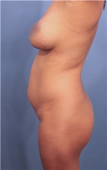 Liposuction Before Photo by Marvin Shienbaum, MD; Brandon, FL - Case 30365