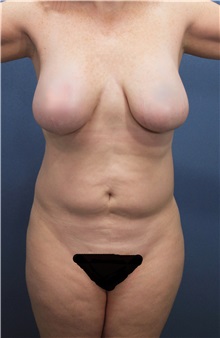 Liposuction Before Photo by Marvin Shienbaum, MD; Brandon, FL - Case 30367