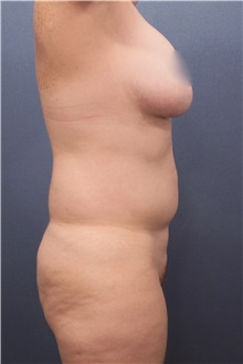 Liposuction Before Photo by Marvin Shienbaum, MD; Brandon, FL - Case 30367