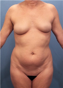 Liposuction Before Photo by Marvin Shienbaum, MD; Brandon, FL - Case 30377