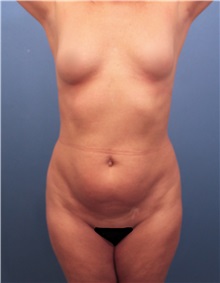 Liposuction Before Photo by Marvin Shienbaum, MD; Brandon, FL - Case 30377