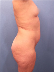 Liposuction Before Photo by Marvin Shienbaum, MD; Brandon, FL - Case 30377