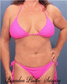 Liposuction After Photo by Marvin Shienbaum, MD; Brandon, FL - Case 30378