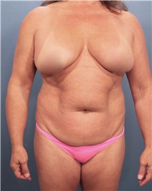 Liposuction Before Photo by Marvin Shienbaum, MD; Brandon, FL - Case 30378