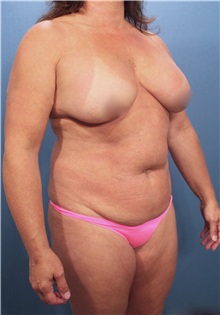 Liposuction Before Photo by Marvin Shienbaum, MD; Brandon, FL - Case 30378