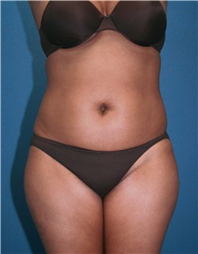 Liposuction Before Photo by Marvin Shienbaum, MD; Brandon, FL - Case 30379