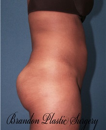 Liposuction After Photo by Marvin Shienbaum, MD; Brandon, FL - Case 30379