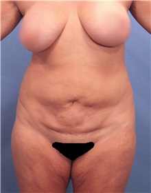 Liposuction Before Photo by Marvin Shienbaum, MD; Brandon, FL - Case 30380