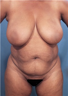 Liposuction Before Photo by Marvin Shienbaum, MD; Brandon, FL - Case 30382