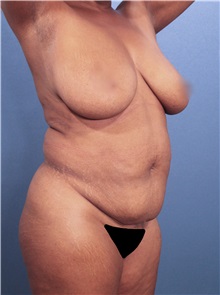 Liposuction Before Photo by Marvin Shienbaum, MD; Brandon, FL - Case 30382