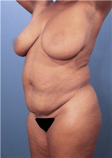 Liposuction Before Photo by Marvin Shienbaum, MD; Brandon, FL - Case 30382