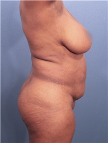 Liposuction Before Photo by Marvin Shienbaum, MD; Brandon, FL - Case 30382