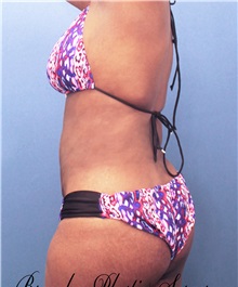 Liposuction After Photo by Marvin Shienbaum, MD; Brandon, FL - Case 30382