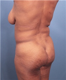 Liposuction Before Photo by Marvin Shienbaum, MD; Brandon, FL - Case 30382