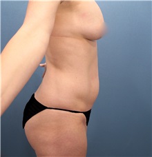 Liposuction Before Photo by Marvin Shienbaum, MD; Brandon, FL - Case 30383