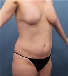 Liposuction Before Photo by Marvin Shienbaum, MD; Brandon, FL - Case 30383